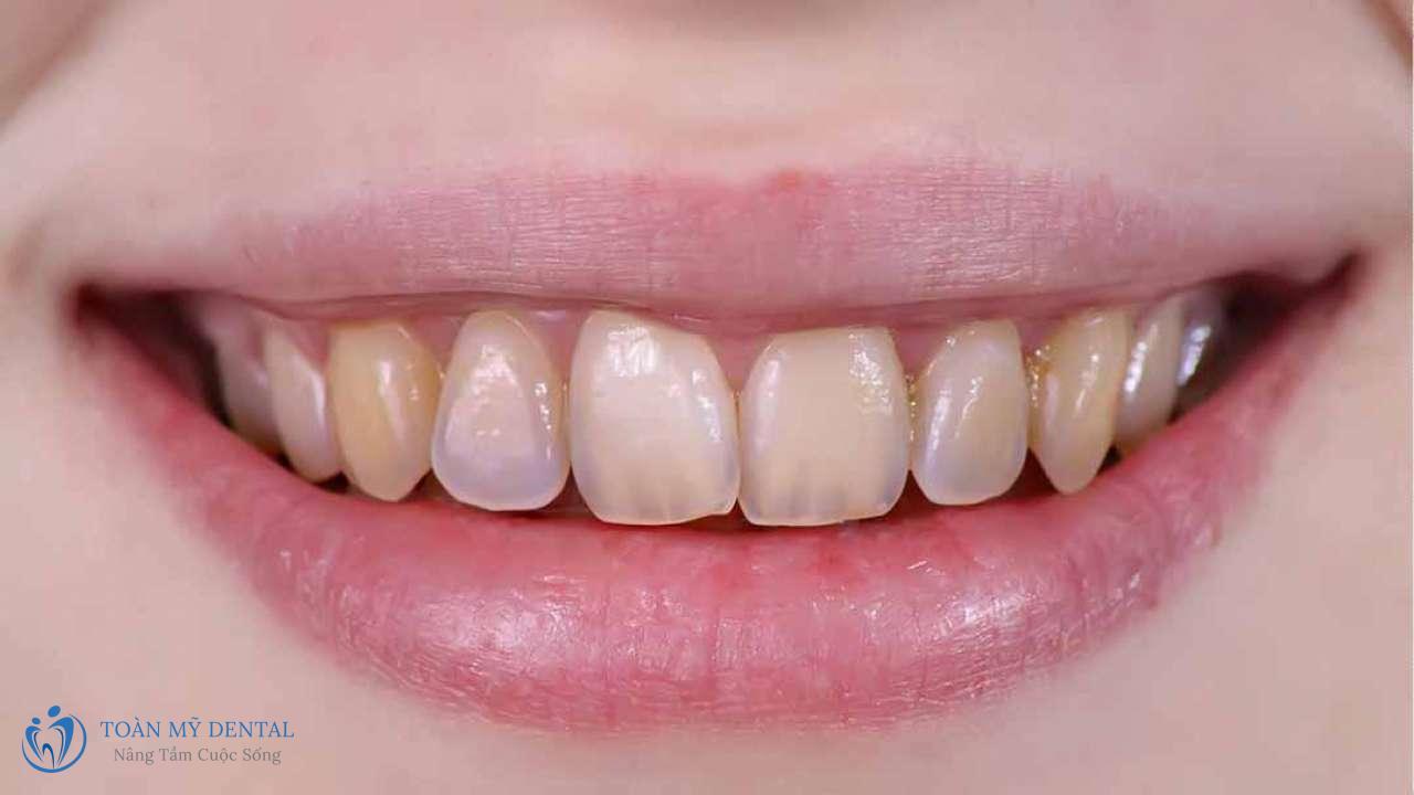 Theo thời gian lớp men răng bị bào mòn