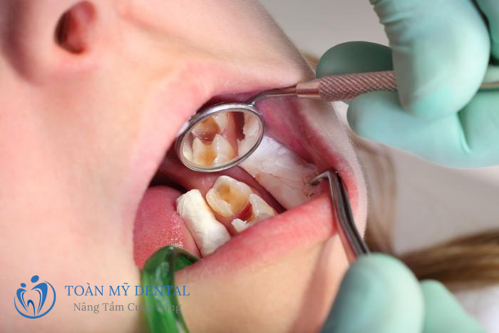Sâu răng là một trong những lý do phải điều trị tủy răng