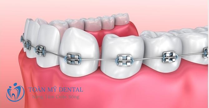 Niềng răng mắc cài kim loại thường