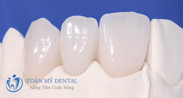 Lava 3M Esthetic hiện đang được khách hàng đặc biệt ưa chuộng.