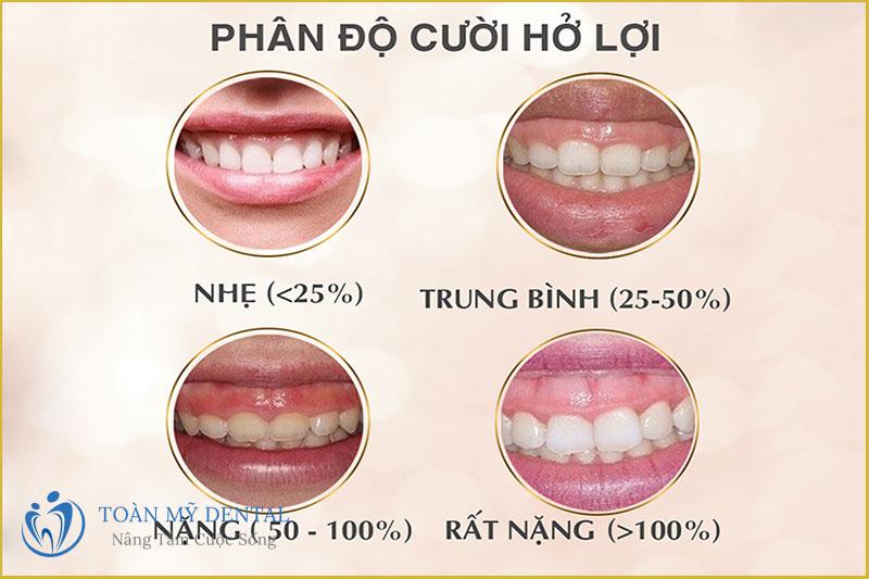 các mức độ cười hở lợi