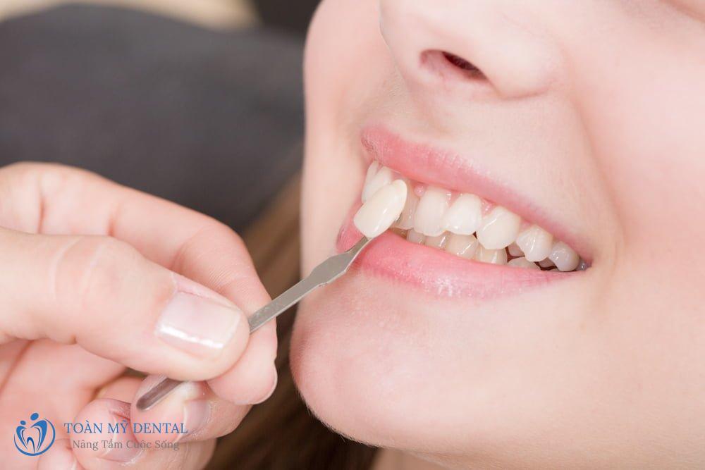 Phương pháp dán sứ Veneer đang là lựa chọn hàng đầu