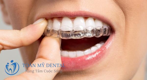các khay niềng được sản xuất và thiết kế riêng cho từng cá nhân khách hàng
