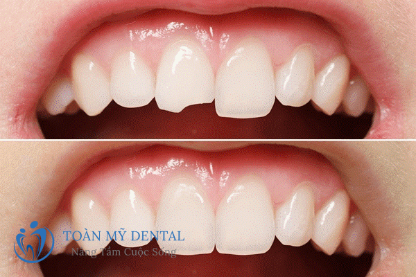 Lợi ích của việc trám răng