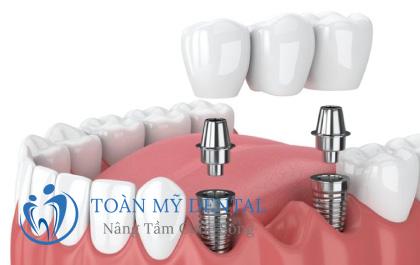 Mất 3 răng liền kề