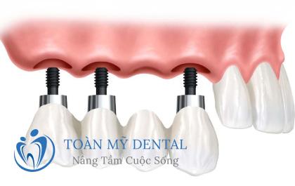 Mất 4 răng liền kề