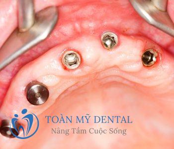 Cấy ghép Implant