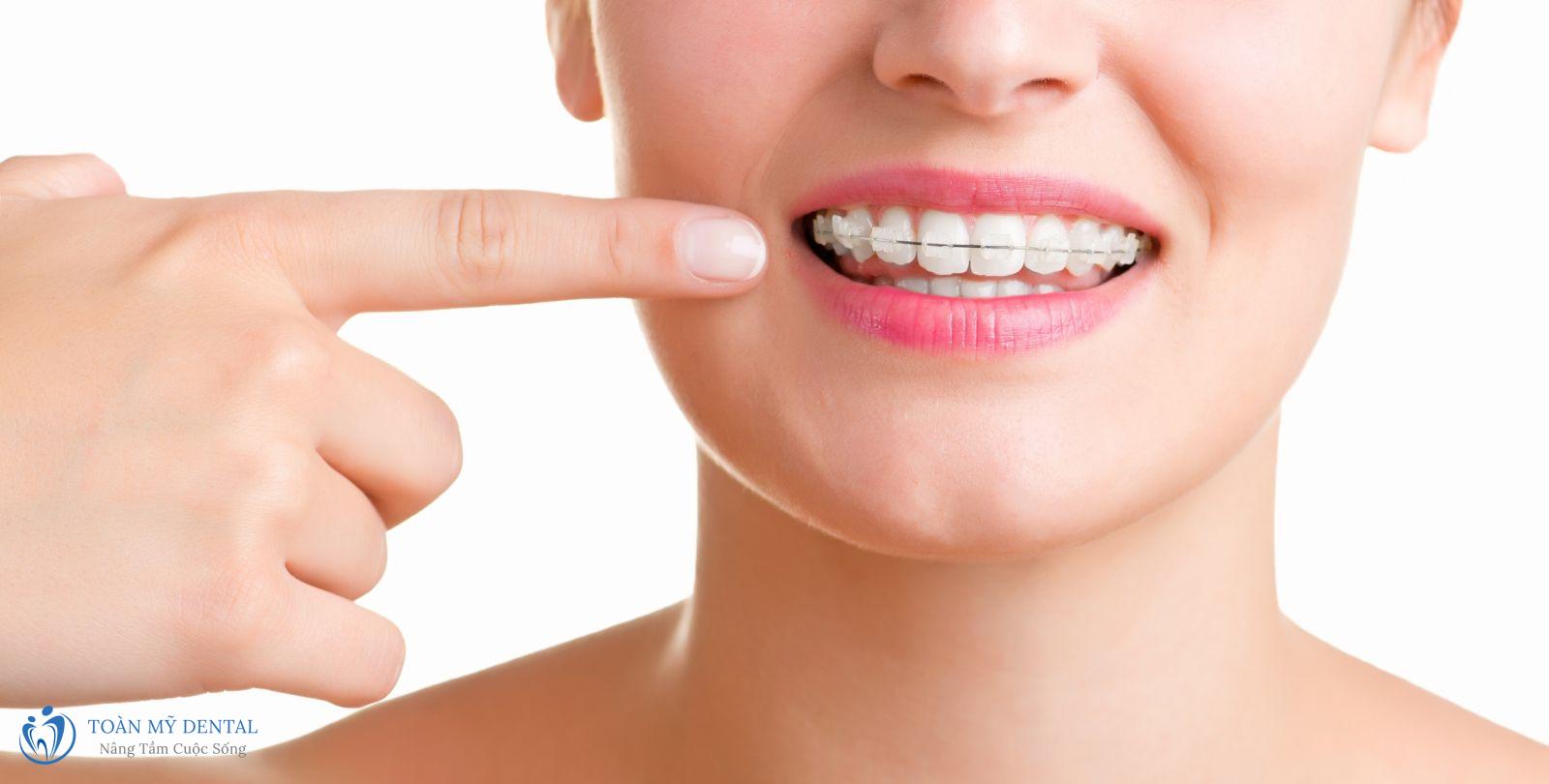 Niềng răng mắc cài sứ