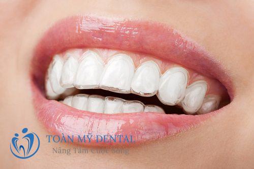 Tự do tháo lắp, dễ dàng vệ sinh