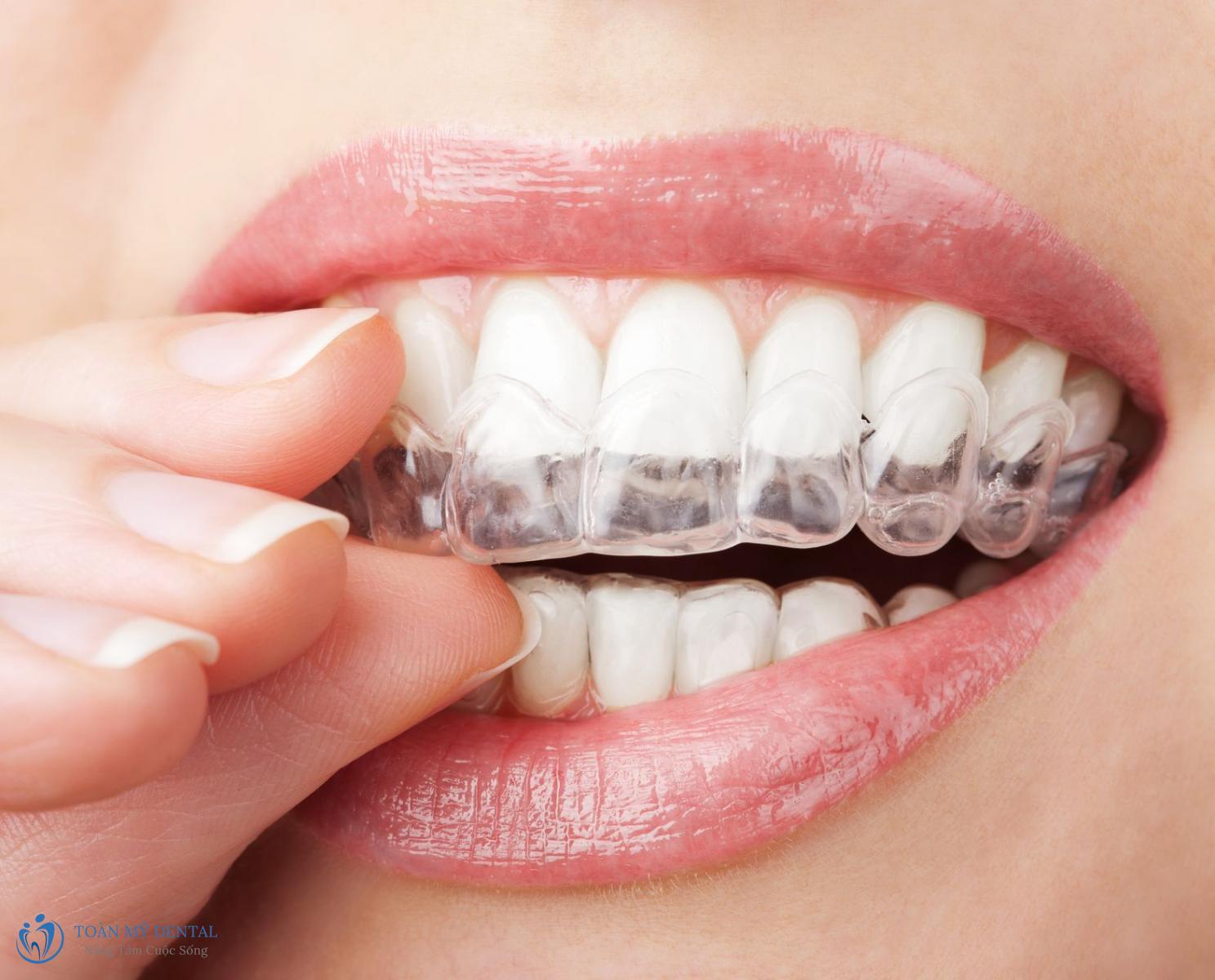 Niềng răng Invisalign