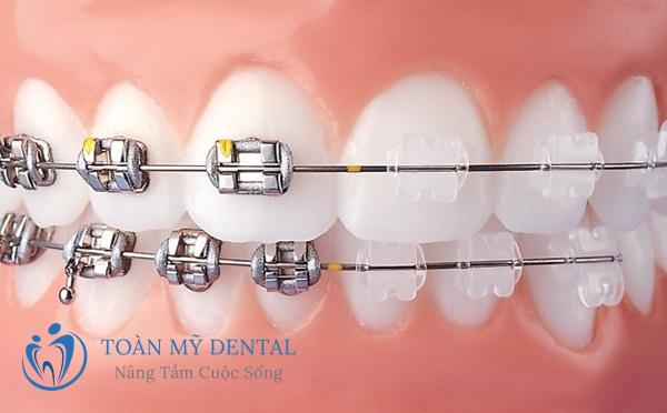 Niềng răng mắc cài kim loại tự đóng/tự buộc