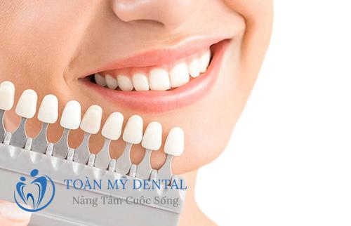Dán sứ veneer