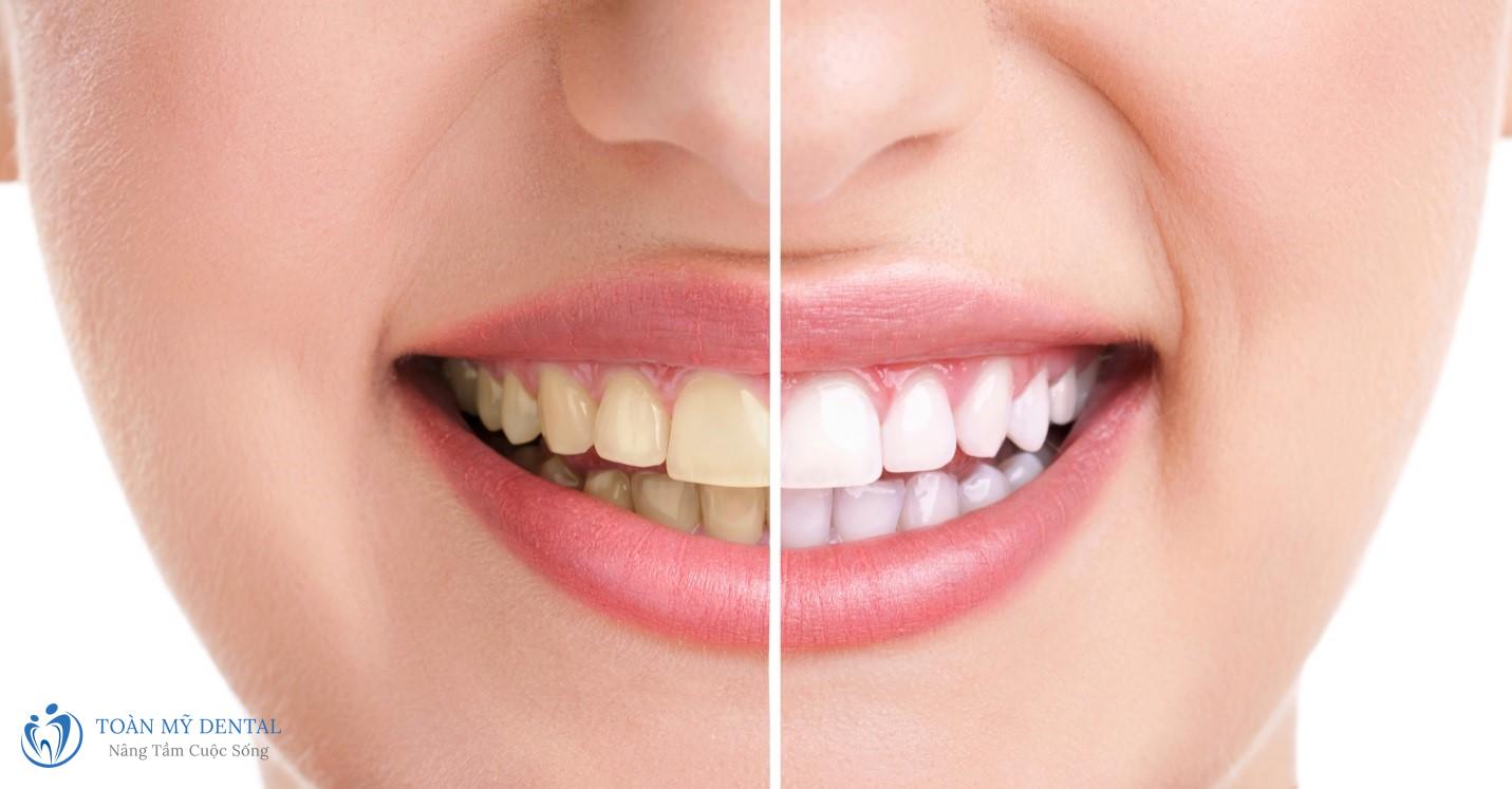 Răng bị xỉn, nhiễm màu, tối màu